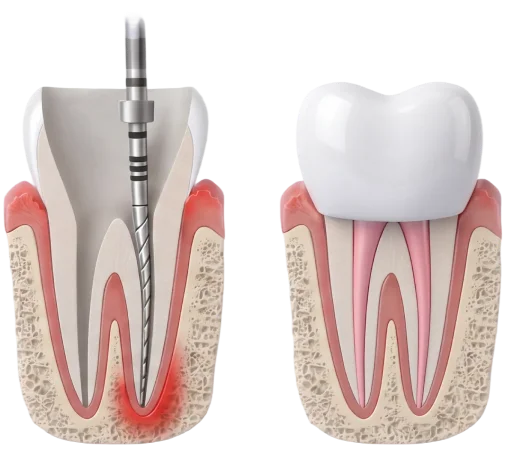 Lechenie pulpitov periodontitov